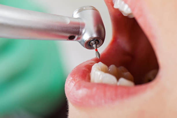 Best Emergency Dentist for Lost Fillings or Crowns in Monroe, IA